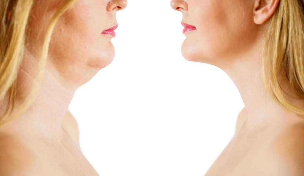 Double Chin treatment Old Oak Common before and after results