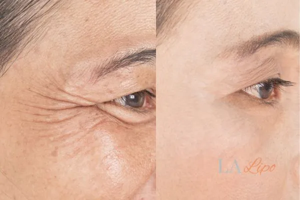 Before and after results of woman - HI-fu wrinkles reduction treatment Old Oak Common