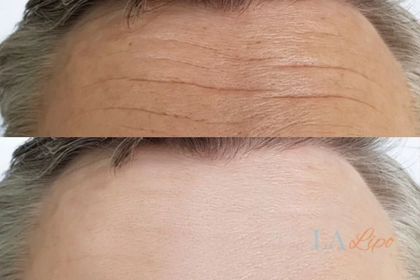 results of HIFU Old Oak Common on mans forehead to help reduce lines and wrinkles