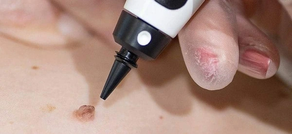 skin tag removal using cryopen Old Oak Common