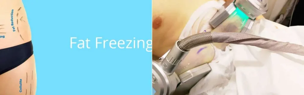 Fat freezing Old Oak Common on multiple areas of the body