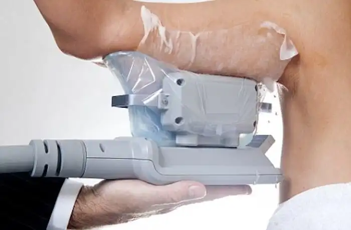 Picture of fat freezing Old Oak Common on the upper arms.
