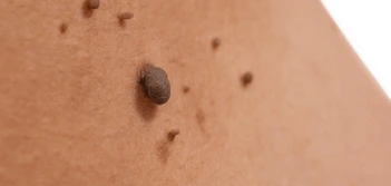 image of a skin tag Old Oak Common