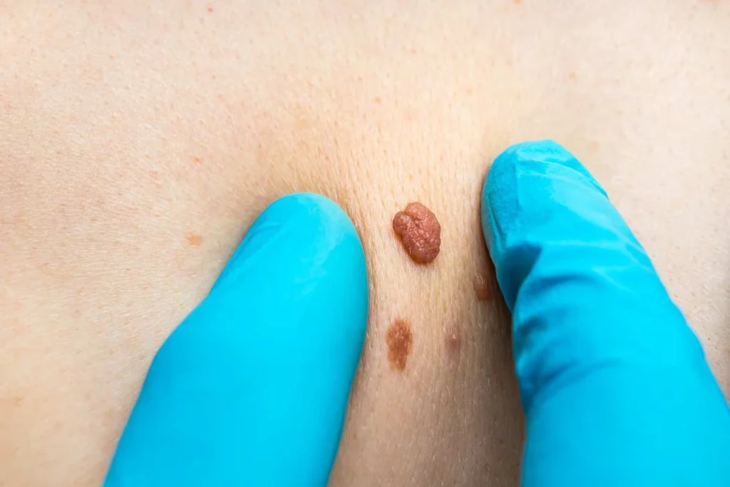Consultant examining a skin tag Old Oak Common