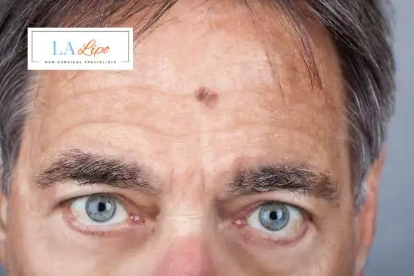 Solar Lentigo Removal Old Oak Common image of man with mark on his forehead