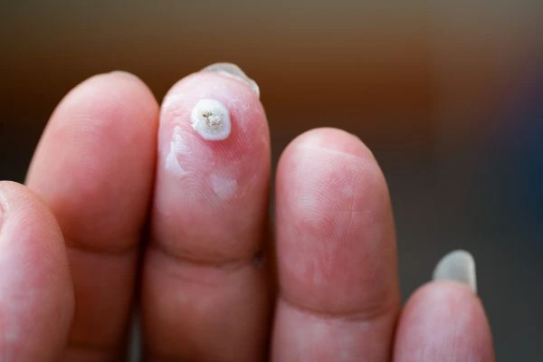 wart on person finger - cryotherapy to treat from LA LIPO Old Oak Common