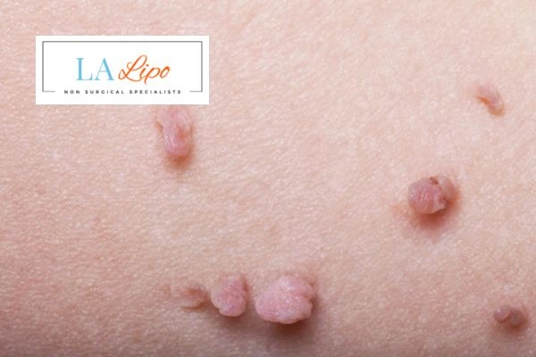 Does cryopen skin tag removal Old Oak Common hurt? Find out now call our team today!