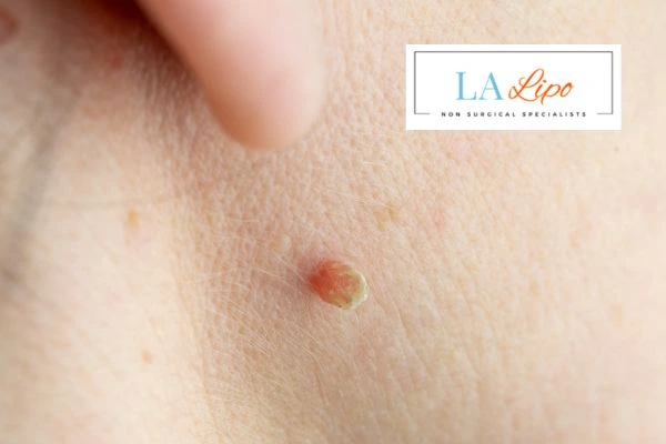 Book skin tag removal Old Oak Common today speak to our team now!