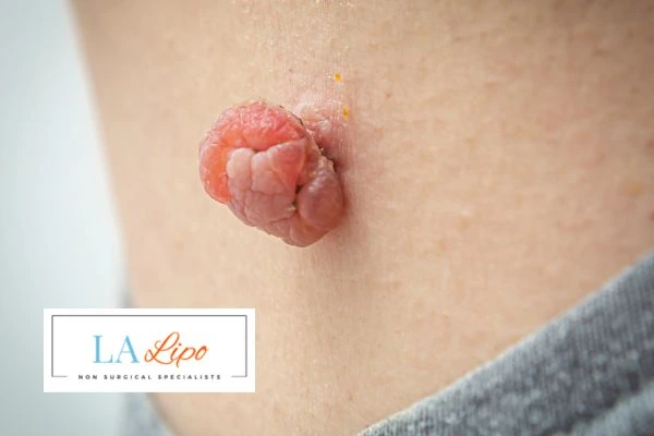 Interested in skin tag removal Old Oak Common? Concerned about the pain? Find out more today!