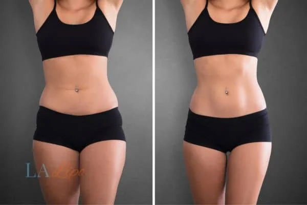 before and after results of non-surgical treatment to help a woman's body image and mental health Old Oak Common