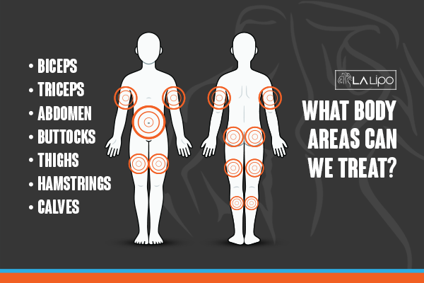 Diagram to show areas you can have LA-EMS Body Sculpting Treatment Old Oak Common