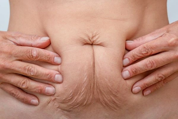 Image of a woman's stomach with loose skin - example of skin tightening Old Oak Common options